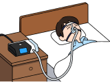 CPAP（シーパップ：経鼻的持続陽圧呼吸療法）